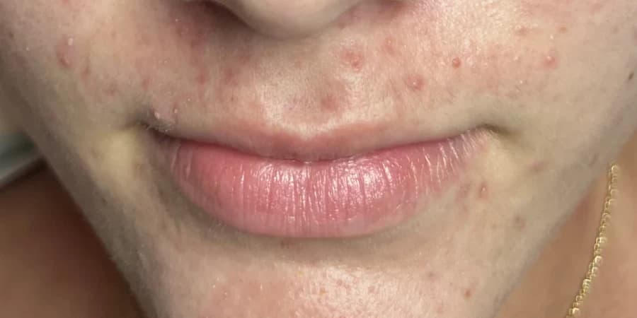 Acne Facial, after