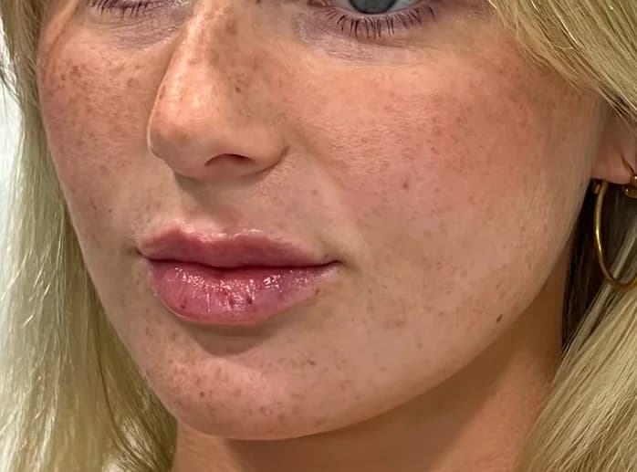 Lip Filler, after
