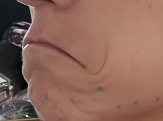 Lower Face Botox (off-label), before