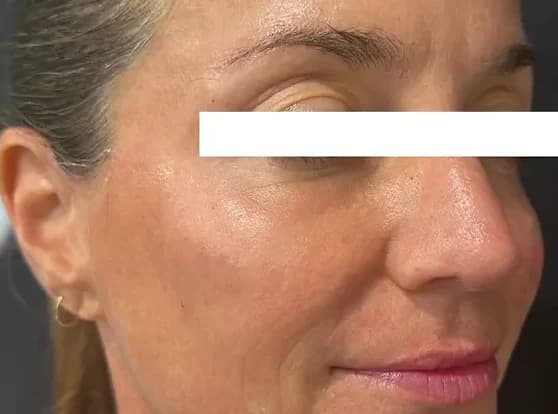 Xeomin, after